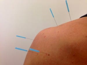 acupuncture dry needling