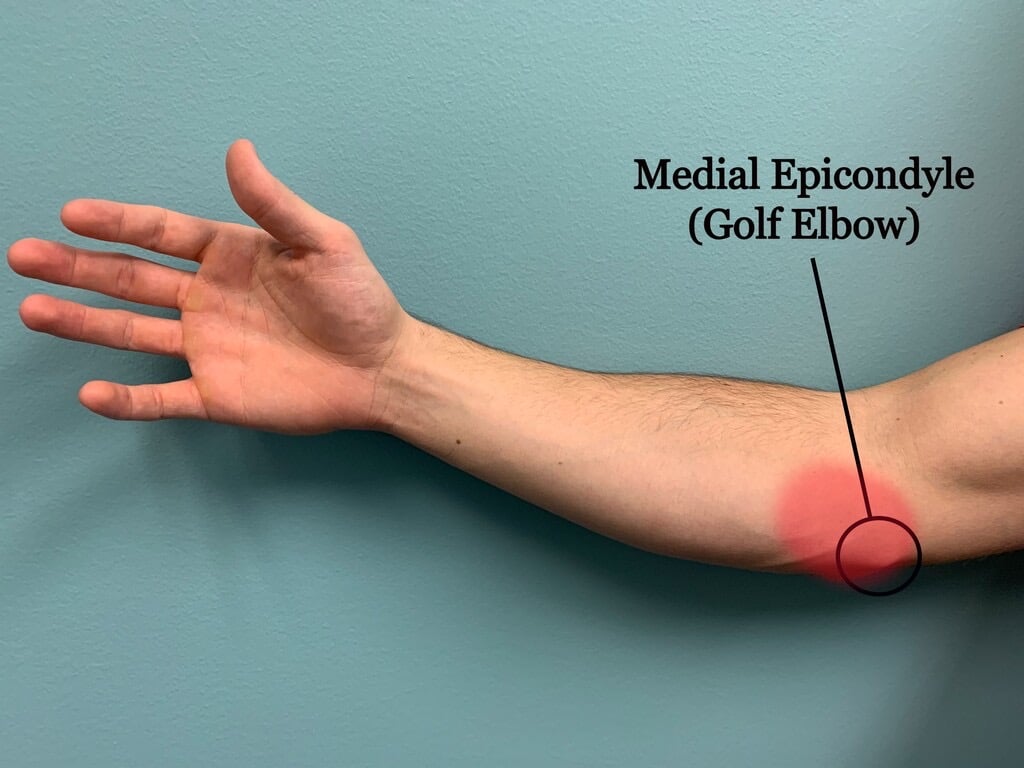 Tennis elbow and golf elbow Tennis elbow and golf elbow are very common. 