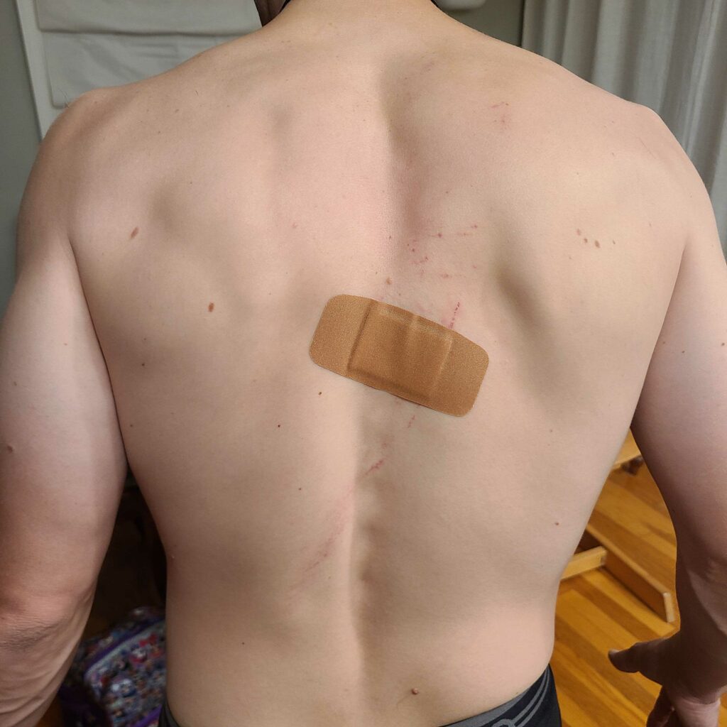 Dr. LoRang's bandaged injury on his back